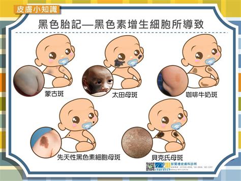 寶寶胎記 氣味分析